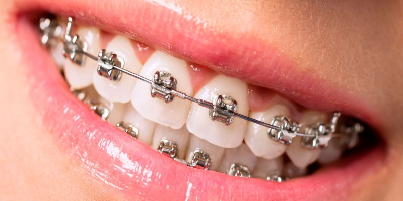 Orthodontie bagues et aligneurs à Agadir