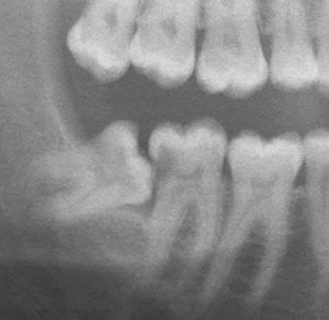 Extraction des dents de sagesse sans douleur